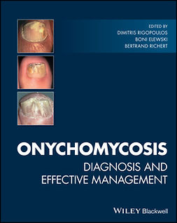 Elewski, Boni - Onychomycosis: Diagnosis and Effective Management, e-bok