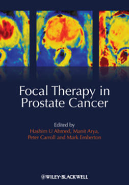 Ahmed, Hashim Uddin - Focal Therapy in Prostate Cancer, ebook