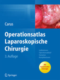 Carus, Thomas - Operationsatlas Laparoskopische Chirurgie, e-kirja