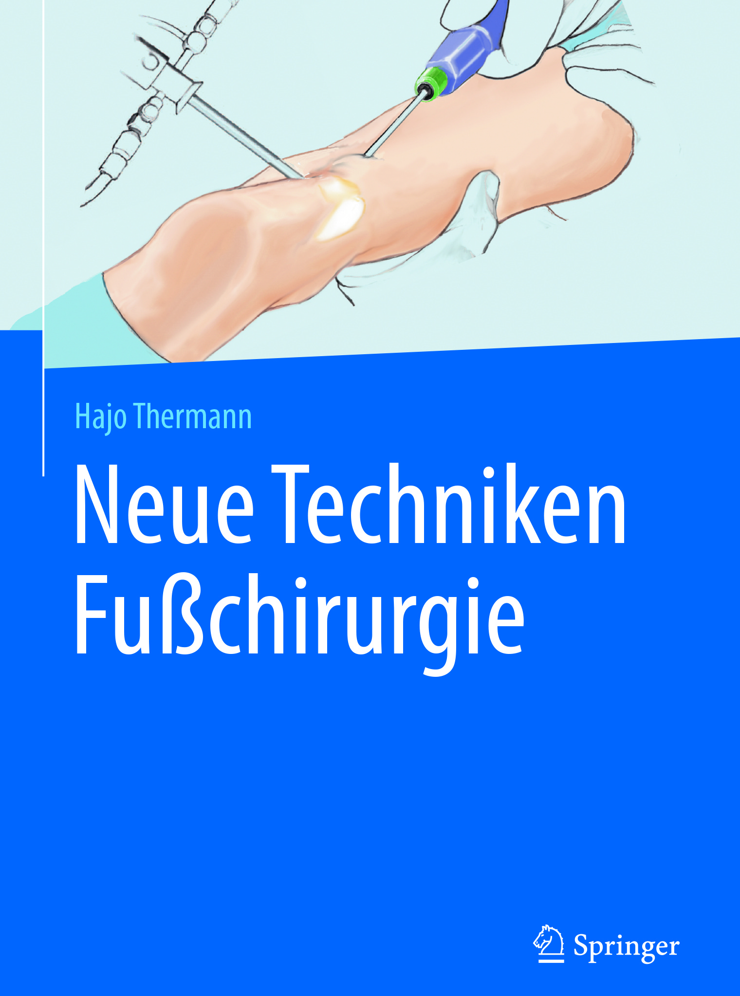 Thermann, Hajo - Neue Techniken Fußchirurgie, e-bok