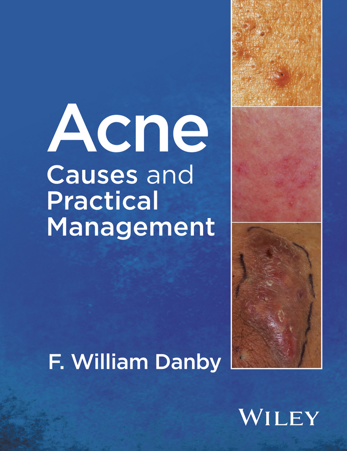 Danby, F. William - Acne: Causes and Practical Management, e-bok